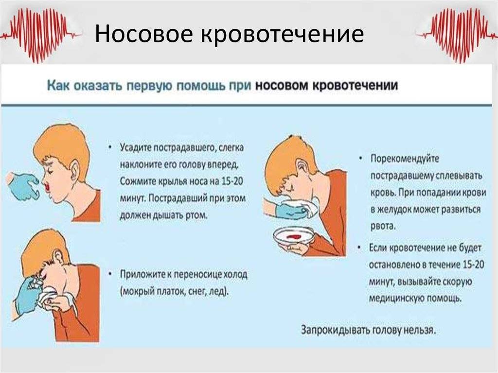 Носовое кровотечение у детей - симптомы болезни, профилактика и лечение носового кровотечения у детей, причины заболевания и его диагностика на eurolab