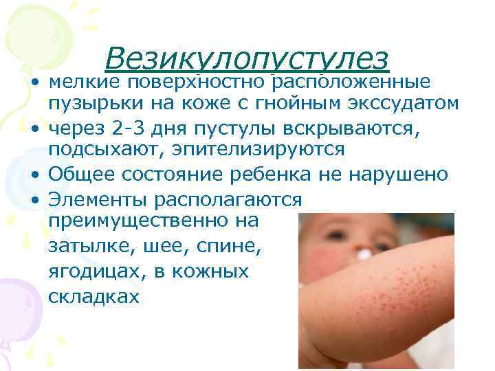 Потница у новорожденных: признаки, лечение и профилактика сыпи