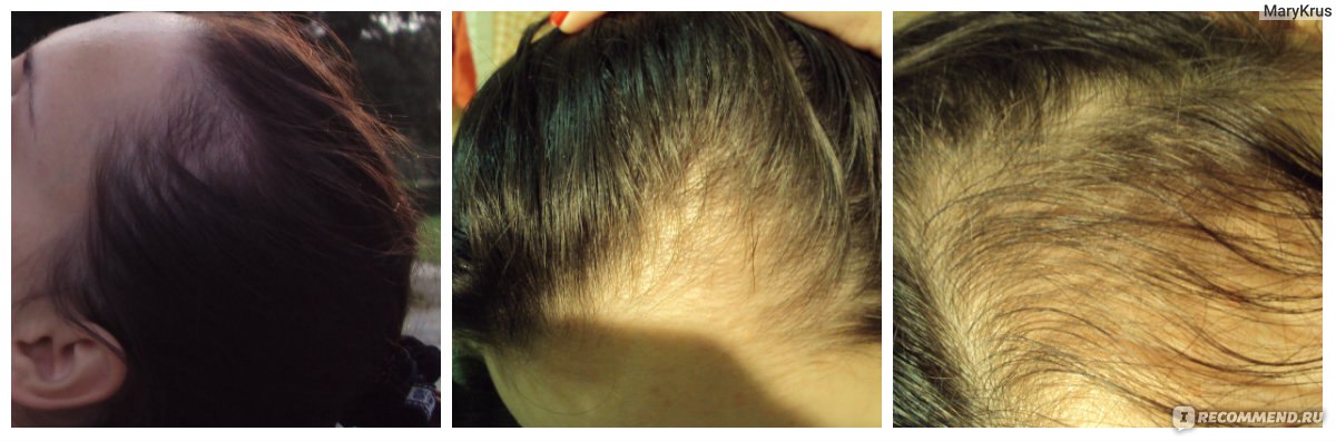 Выпадают волосы после родов. когда это закончится и что делать? | nutrilak