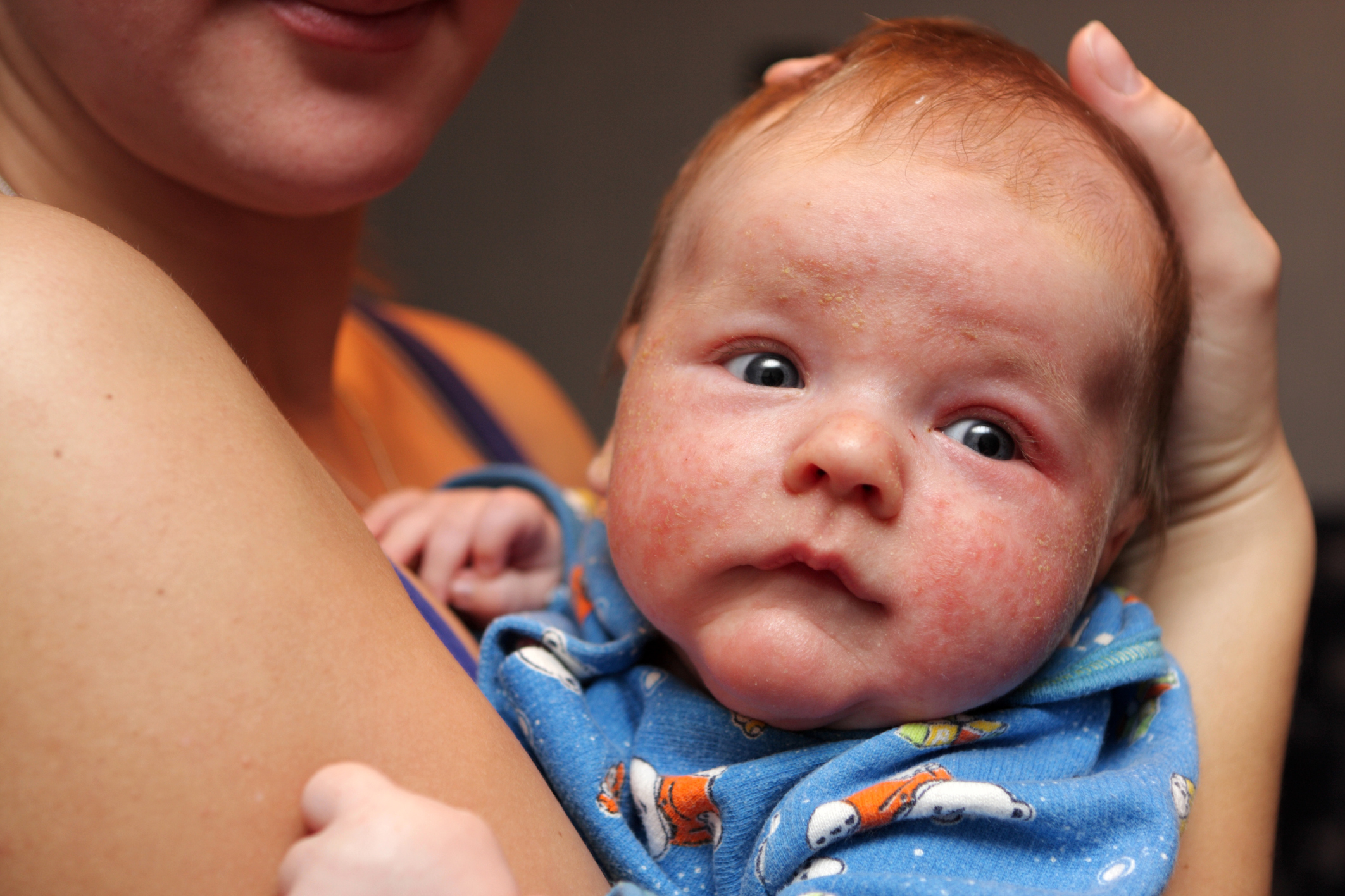 Стафилококк у новорожденных детей: лечение ребенка, симптомы, в носу, кале, горле, кишечнике