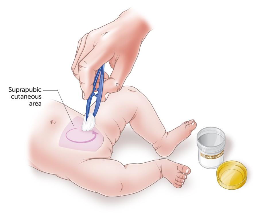 Как собрать мочу у грудничка (девочки, мальчика): мочеприемник для новорожденных