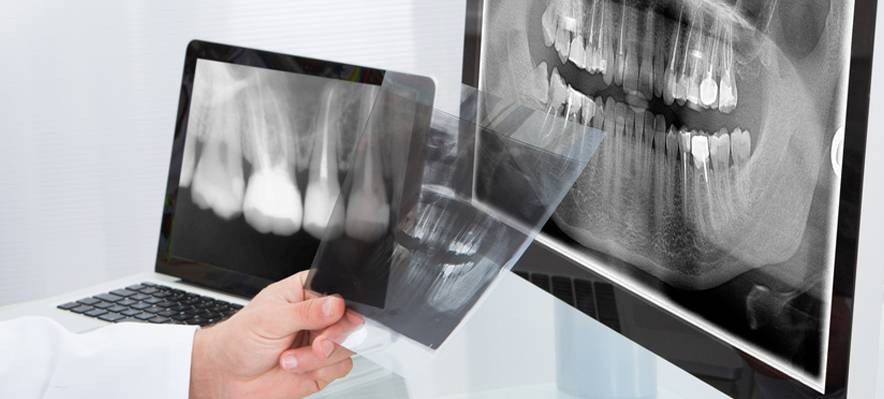 Рентген зуба: когда нужен и как делают | food and health