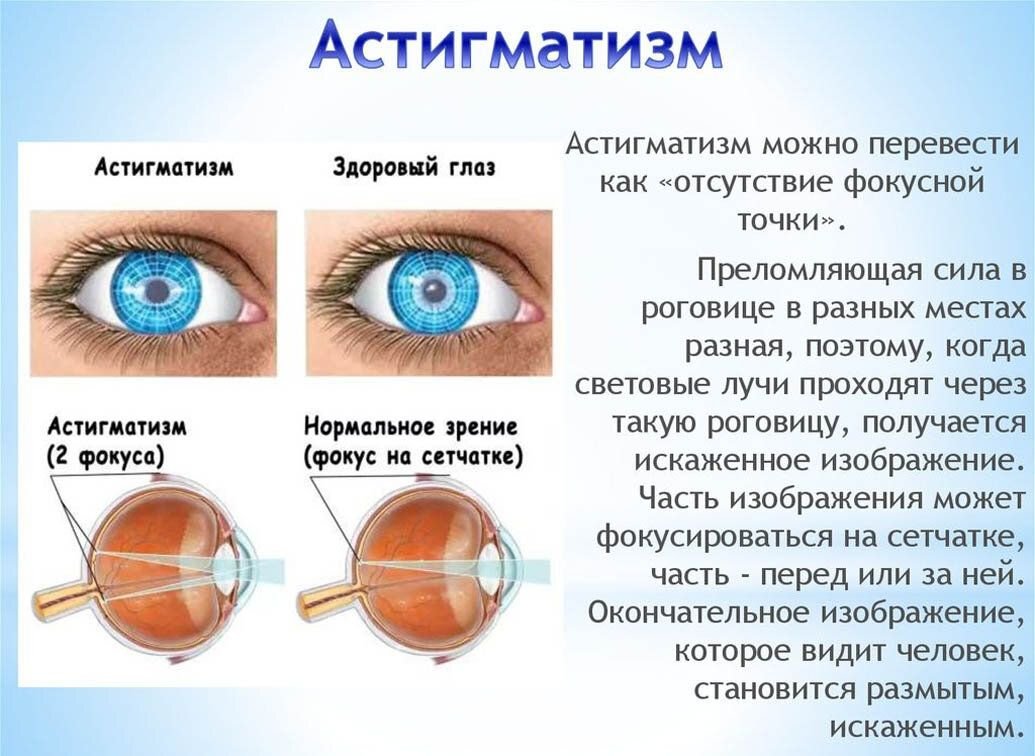 Астигматизм глаз - лечение, симптомы, причины возникновения болезни, виды, степени
