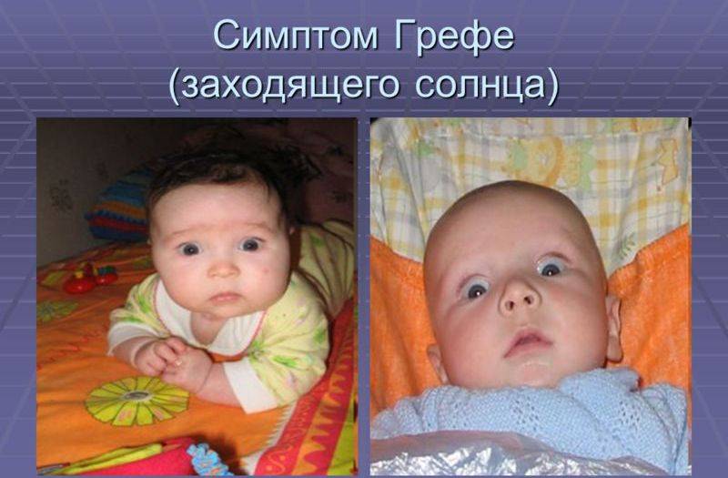 Синдром вегетативной дистонии - лечение, симптомы, причины заболевания, диагностика и профилактика