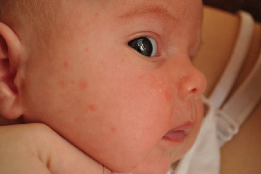 Сыпь на лице у ребенка: причины, все виды высыпаний с фото и методы лечения