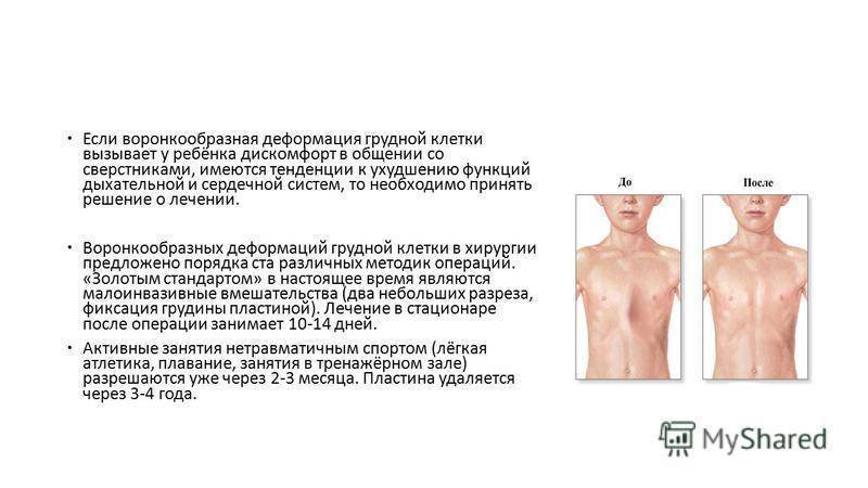 Причины и лечение воронкообразной деформации грудной клетки у детей