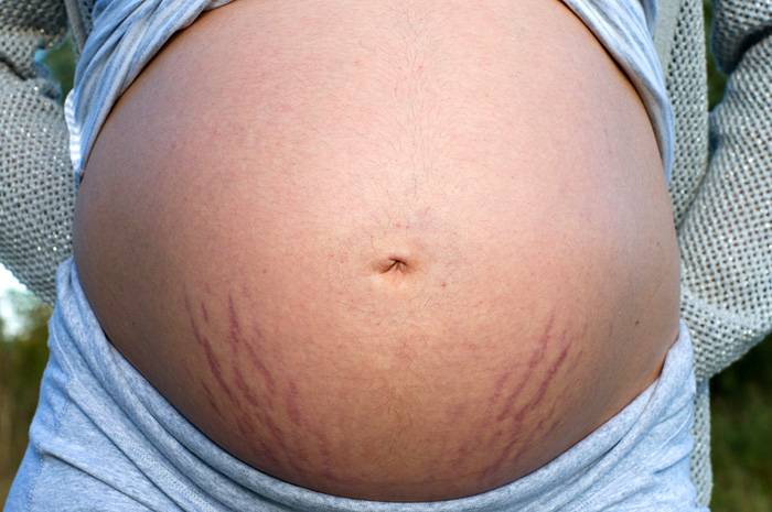 От дистаза до грыжи: что происходит с телом после родов