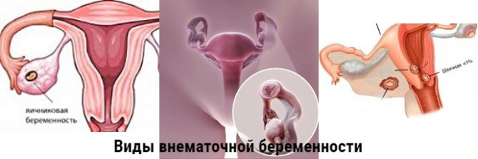 Эндоскопическая операция (удаление) по внематочной беременности на ранних сроках: показания и противопоказания, послеоперационный период