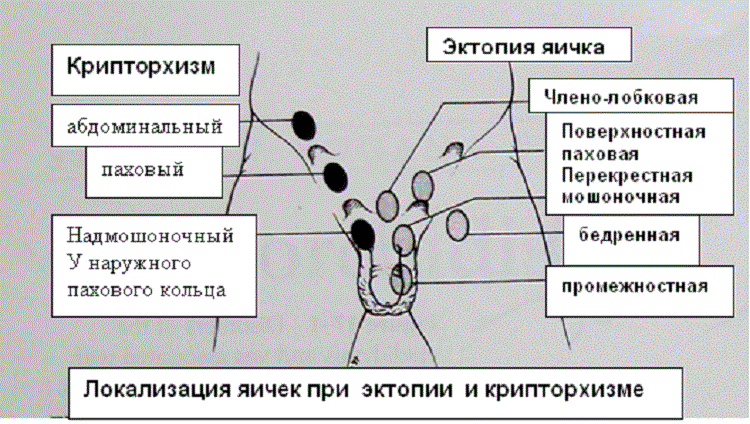 Схема опускания яичка