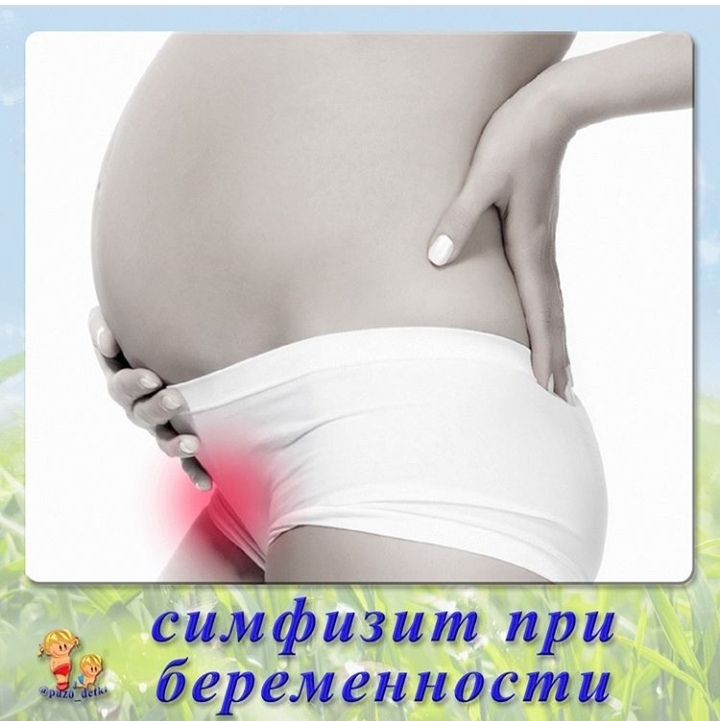Симфизит при беременности: симптомы и лечение, возможные осложнения - spuzom.com