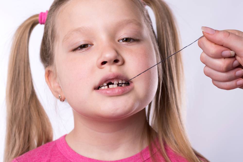 Шатается молочный зуб у ребенка что делать?