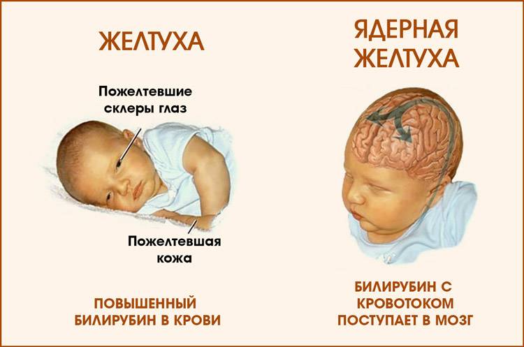 Желтуха у новорожденных – физиологическая и патологическая, симптомы и лечение - isida