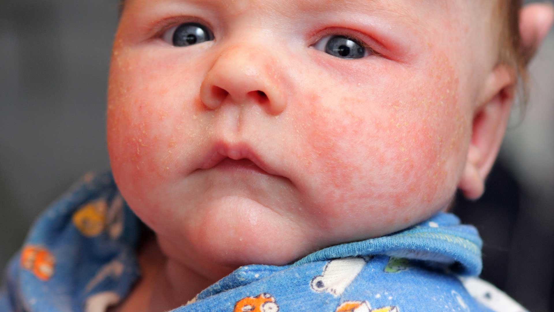потничка у новорожденных фото на лице