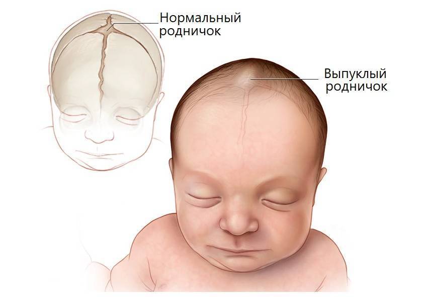 Когда зарастает родничок у новорождённого (сроки, рано или поздно и пр) + комаровский