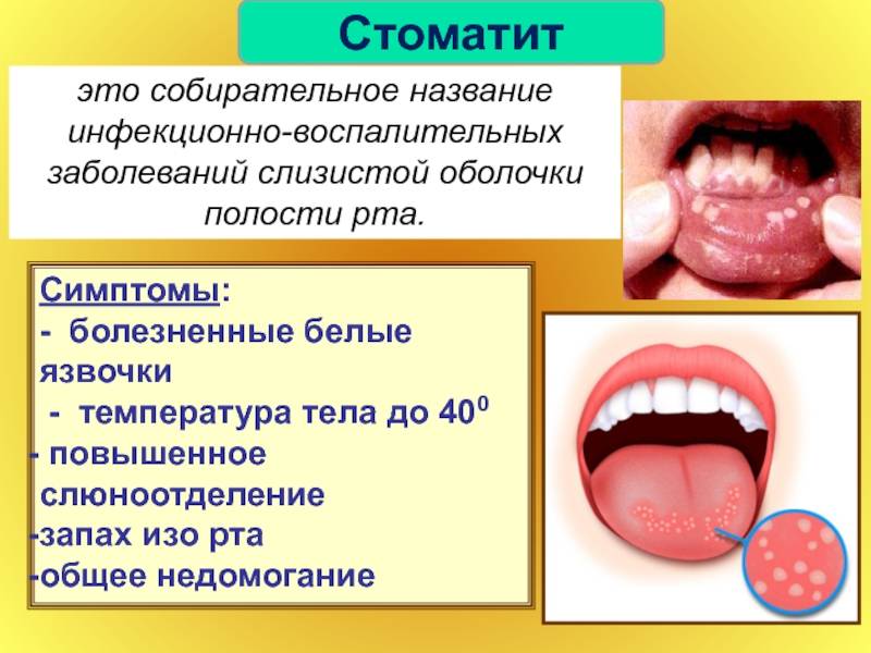 Почему появляются язвы во рту, лечение | стоматология в алтуфьево