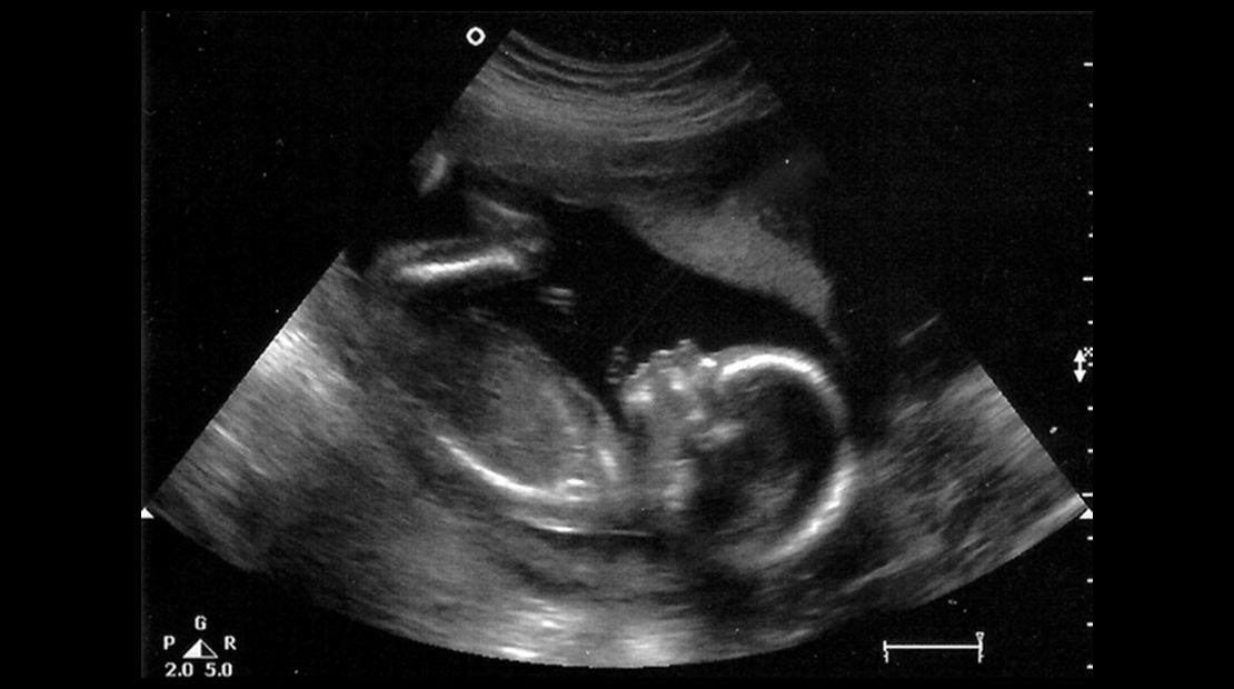 3 недели беременности после эко - клиника «к+31»