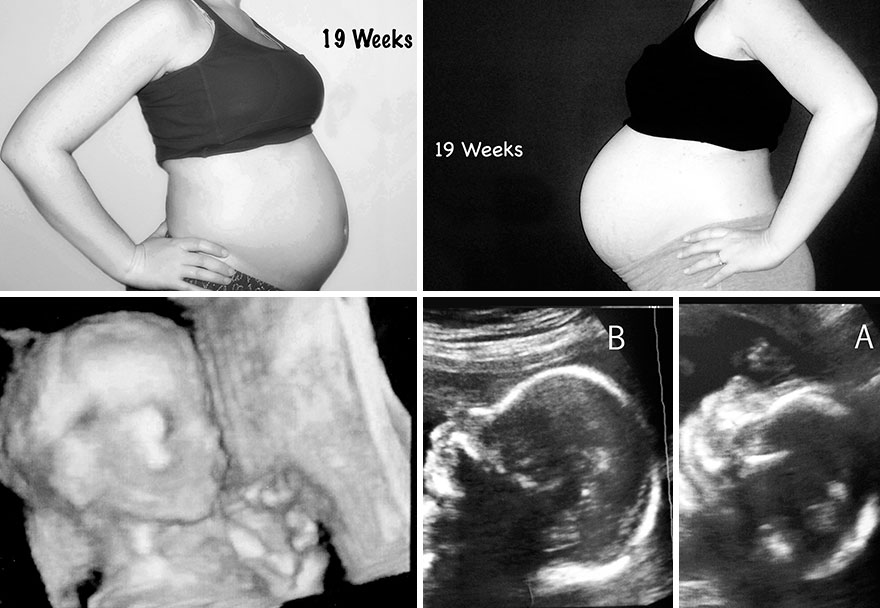 Как выглядит живот беременной на 18 неделе беременности фото