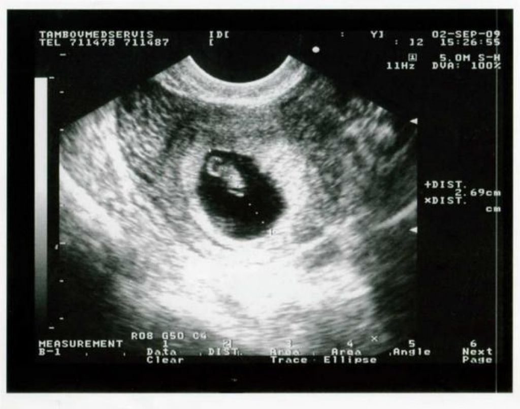 Узи плод 5 недель. Эмбрион 5 6 недель беременности УЗИ. УЗИ 5-6 недель беременности. 5 Недель беременности фото плода на УЗИ. Снимок УЗИ беременности 4-5 недель.