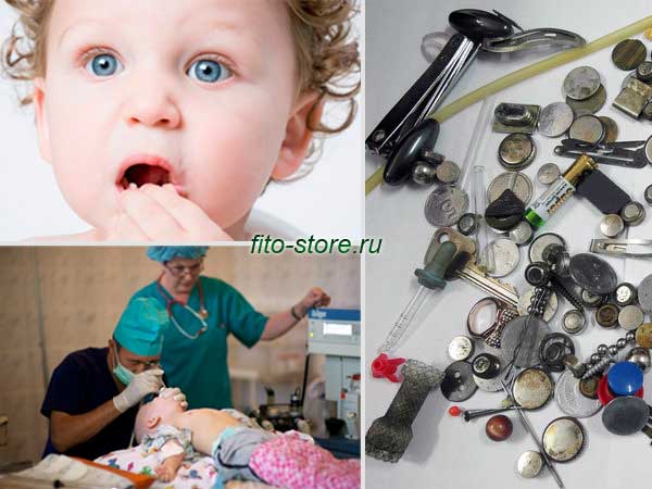 Инородное тело в желудке