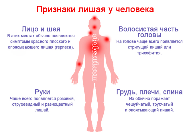 Лишай | симптомы | диагностика | лечение - docdoc.ru