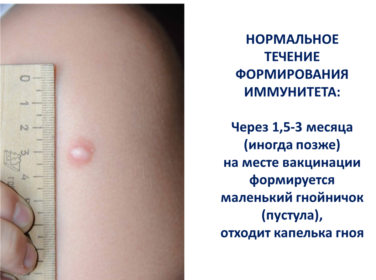 После второго укола. Прививка БЦЖ норма реакции. БЦЖ прививка реакция ребенка 2 года. Прививка БЦЖ период заживления.