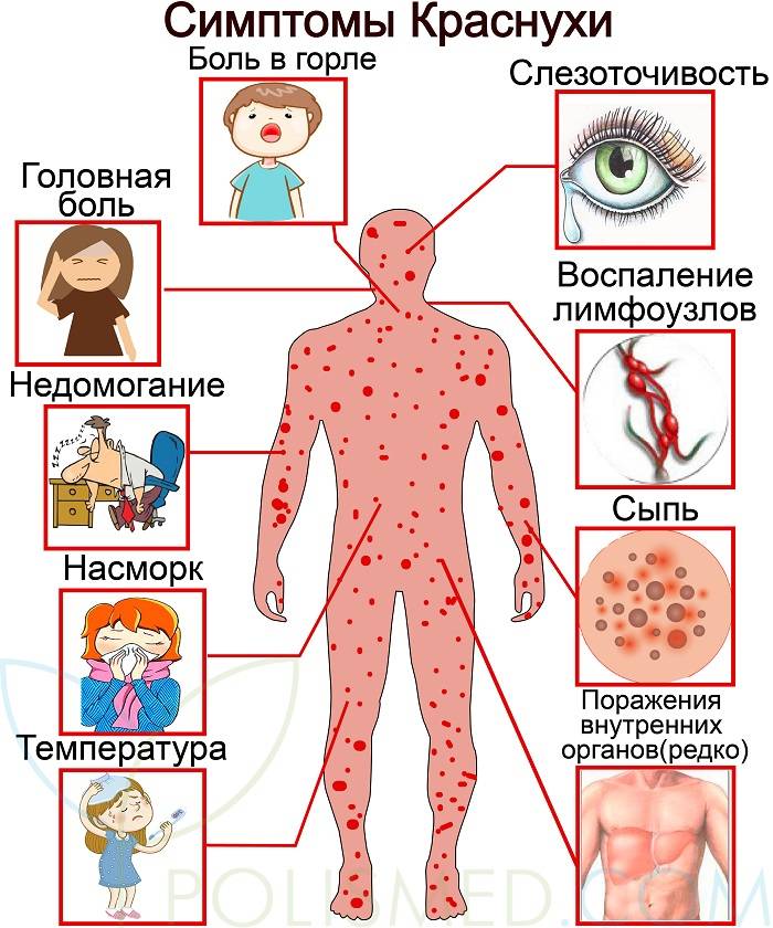 Ветрянка у детей: первые признаки и 6 главных симптомов, лечение, осложнения, прививка