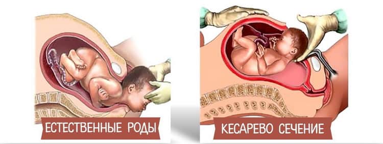 Естественные роды после кесарева сечения | самостоятельные роды после кесарева