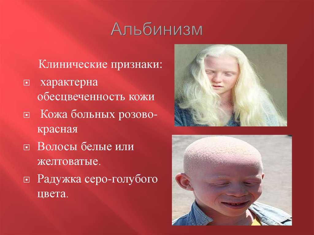 Люди альбиносы: фотографии и интересные факты - topcafe.su - 1 октября - 43583757537 - медиаплатформа миртесен