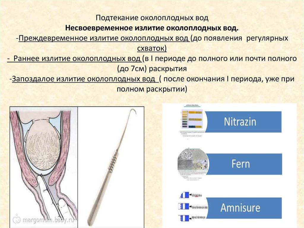 Подтекание околоплодных вод на 39 неделе фото
