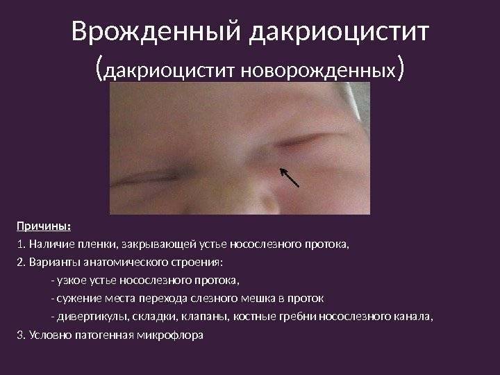 Гноится глаз у новорожденного. что делать? | nutrilak