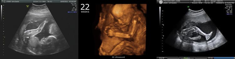 Фото узи 22 недели беременности мальчик