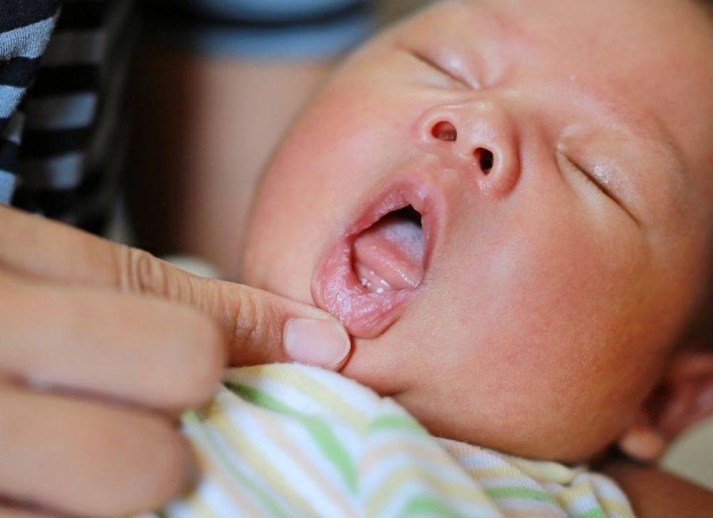 Мозоль (водянка) на губе у новорожденного: как лечить | medisra.ru