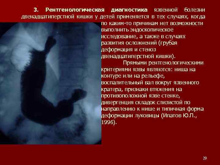Язва двенадцатиперстной кишки