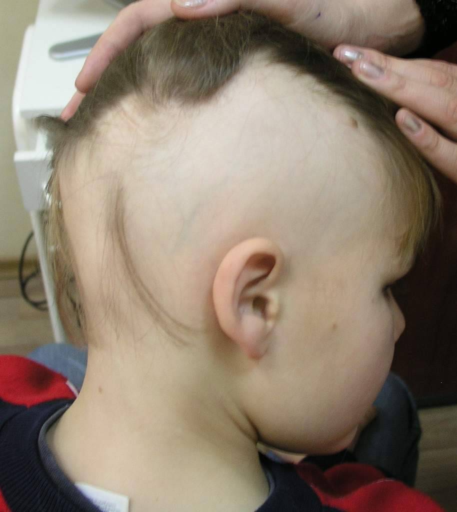 На голове у новорожденного выпадают волосы? без паники!