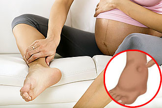 Почему у беременных отеки ног. Отекшие ноги при беременности. Опухшие ноги при беременности.