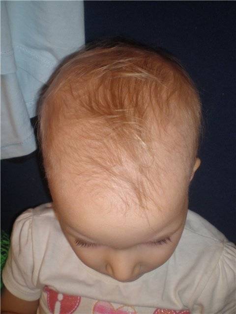У ребенка плохо растут волосы: что делать, если они выпадают у новорожденного?