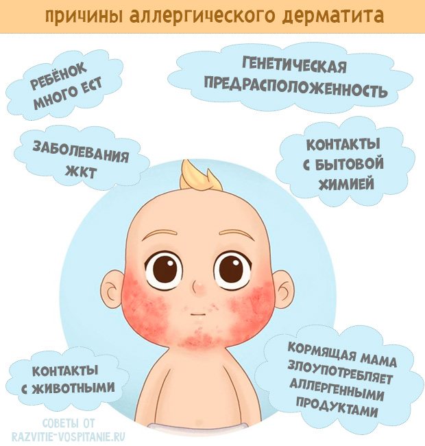 Дерматит у ребенка: 4 основных вида дерматита у детей и обзор самых эффективных лекарственных средств