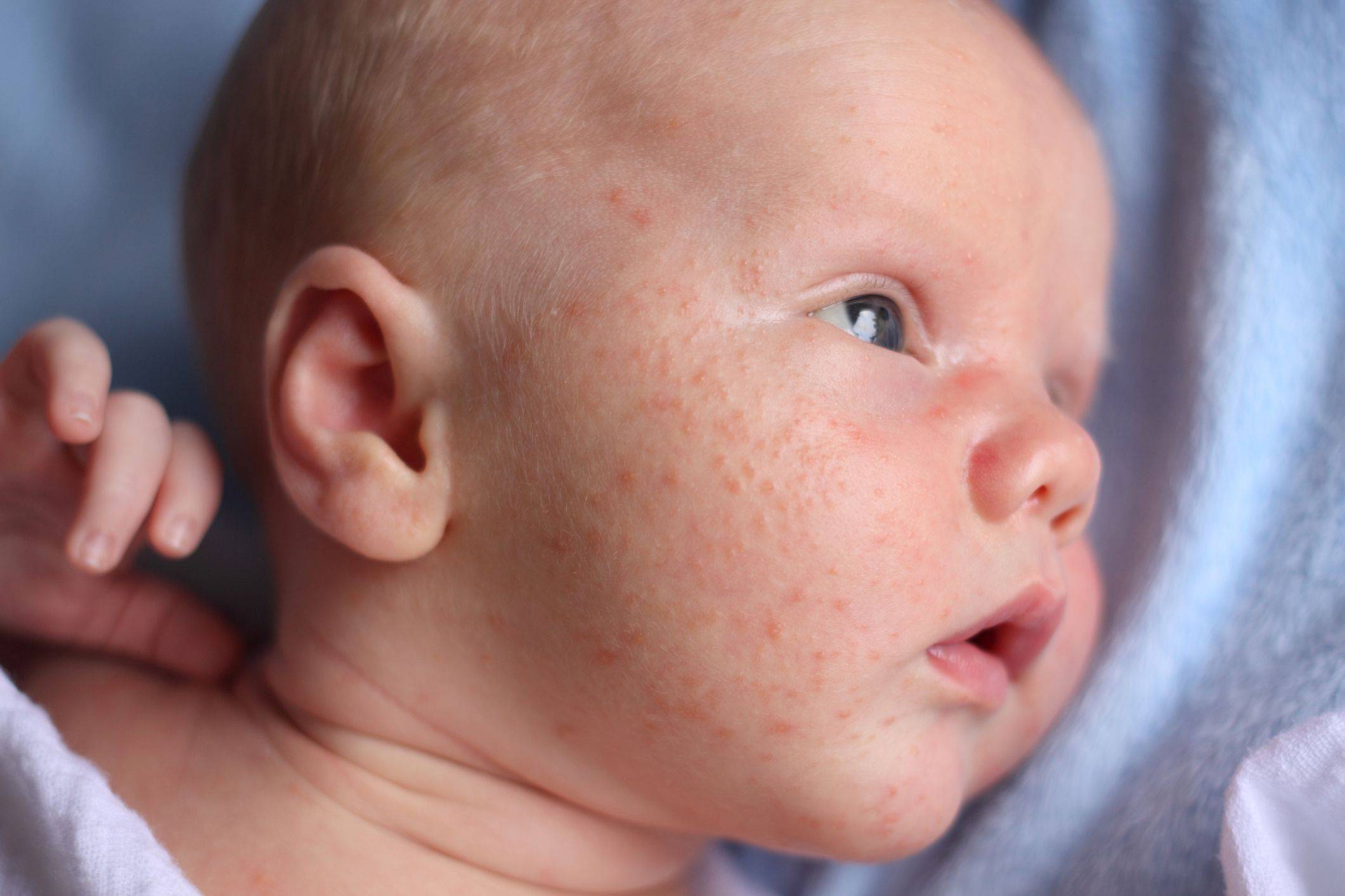 Как проявляется аллергия на смесь у новорожденного грудничка и что делать?