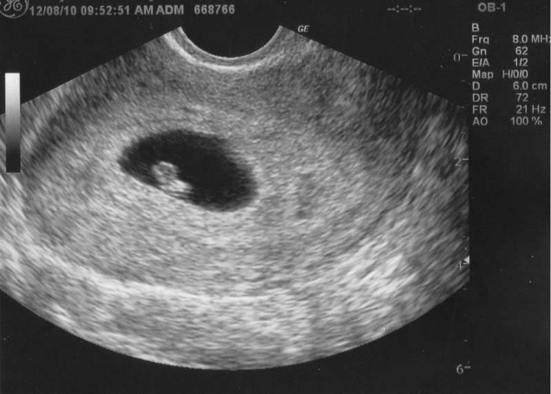 6 неделя беременности