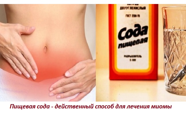 Пить соду при беременности. Народные средства от миомы матки. Лекарство от миомы матки. Спринцевание содой. Таблетки от миомы.