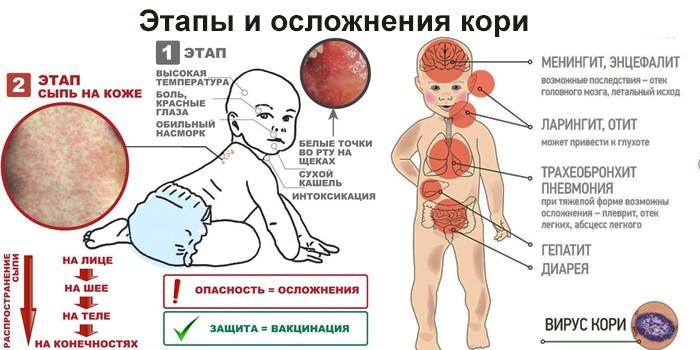 Аденовирусная инфекция у детей: симптомы и лечение, диагностика, осложнения