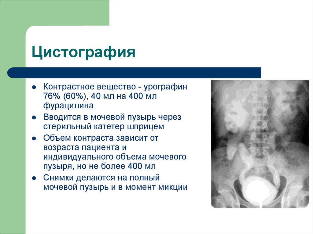 Как проводится цистоуретрография: описание исследования мочевого пузыря и уретры | клиники «евроонко»