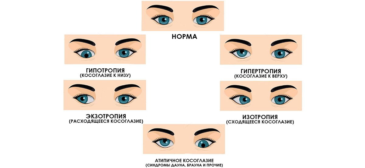 Исправление косоглазия у детей до года - энциклопедия ochkov.net