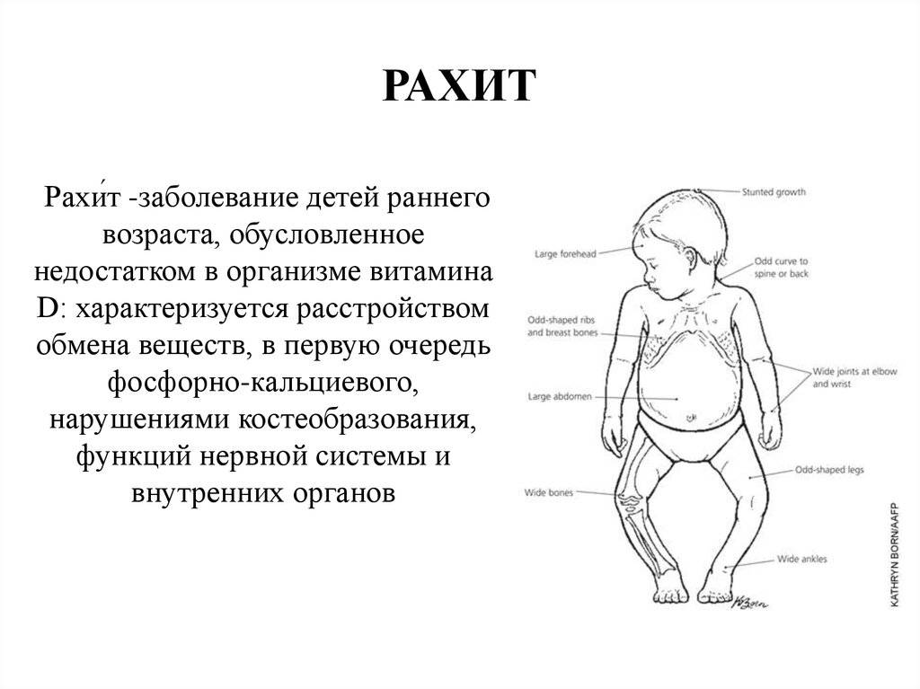 Рахит | симптомы | диагностика | лечение - docdoc.ru