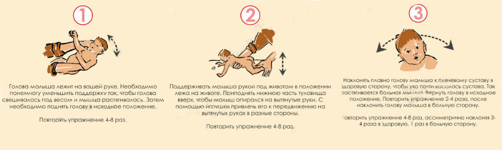 Установочная левосторонняя и правосторонняя кривошея у новорожденных и грудничков