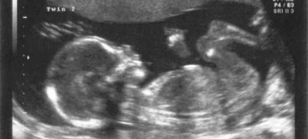 17 неделя беременности: что происходит? ощущения женщины на 17-й неделе :: syl.ru