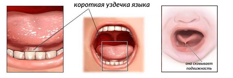 Пластика уздечки губы или языка. когда и как проводятся. вопросы к врачу.