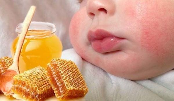 Развитие аллергии на грудное молоко