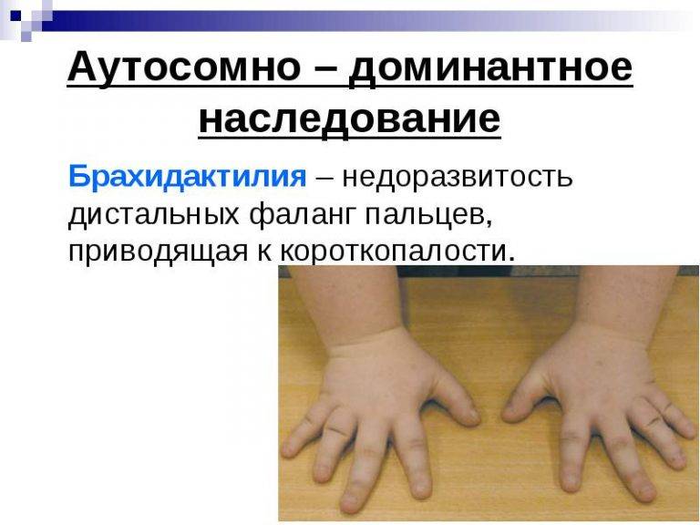Брахидактилия. короткие пальцы у ребёнка: особенность или серьёзная патология?