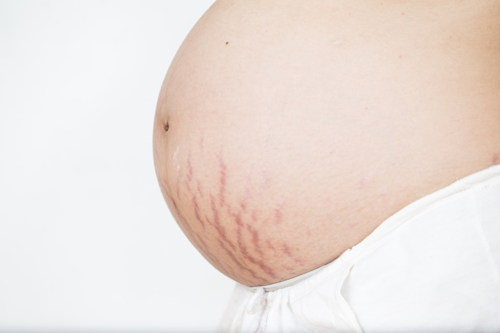 Почему возникают стрии у беременных? лучшие средства от растяжек!